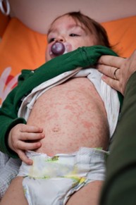 Trẻ bị sốt, nổi mụn đỏ toàn thân có phải triệu chứng của bệnh sởi?